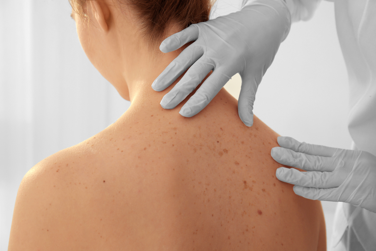 Traitement des tâches de peau | Clinique Médico Esthétique Longueuil