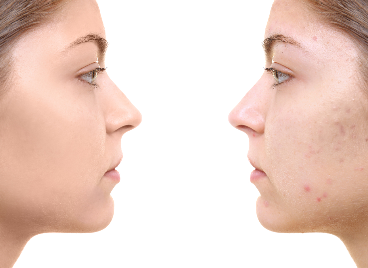 Traitement de l'acné | Clinique Médico Esthétique Longueuil