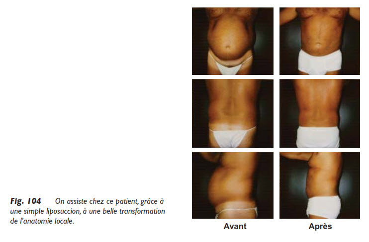 abdomen, Liposuccion de l’abdomen, Medicoesthetique.com
