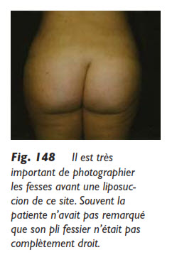 fesses, La liposuccion des fesses, Medicoesthetique.com