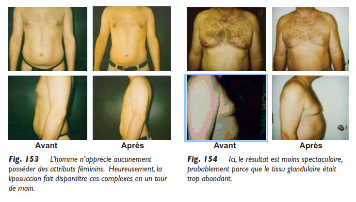 seins, La liposuccion des seins chez l’homme, Medicoesthetique.com
