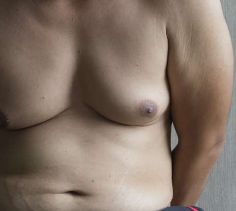 La liposuccion des seins chez l’homme